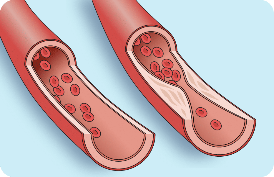 Narrowed Artery and an Open Artery