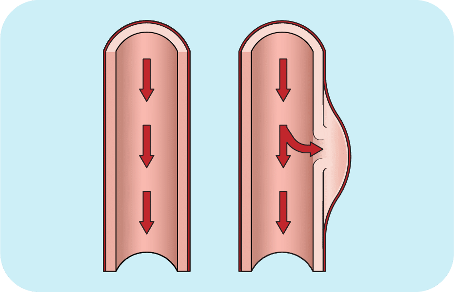 Radiofrequency Device for Relief of Aortic Dissection